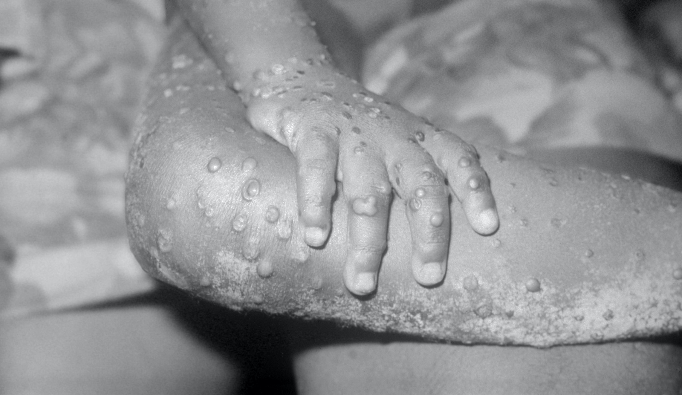 US recorded 17 cases of monkeypox in May, mostly in gay and bisexual men: CDC