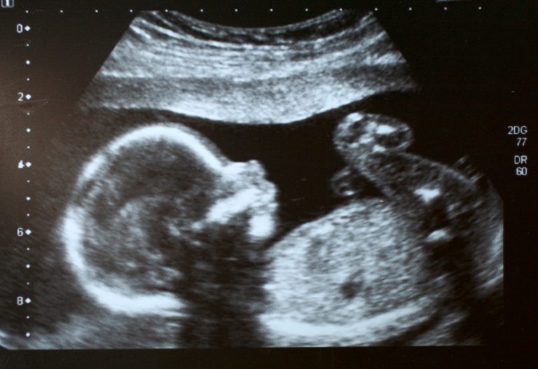How being anti-war made me pro-life
