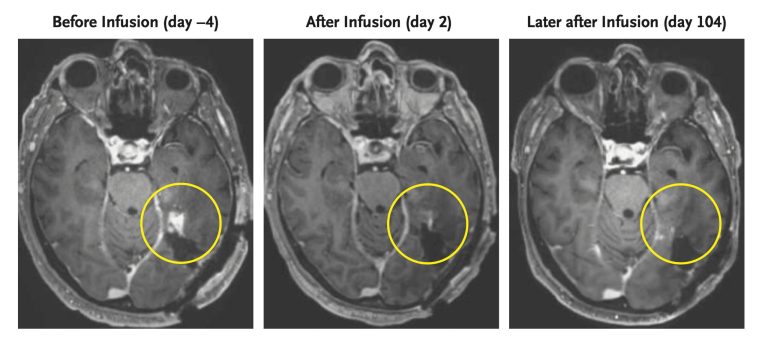 Cell therapy appears to shrink aggressive brain tumors