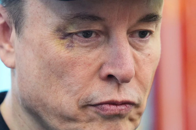 Musk seen with black eye at Trump press conference, blames his son X
